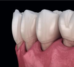 Teeth with receding gums